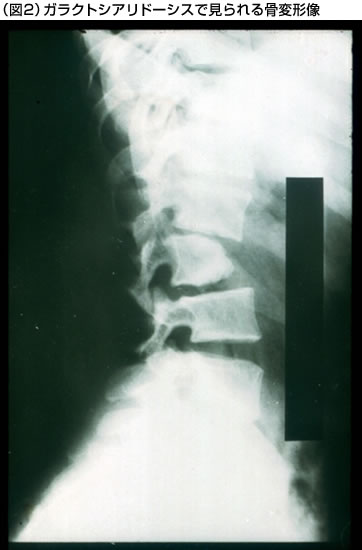 （図2）ガラクトシアリドーシスで見られる骨変形像